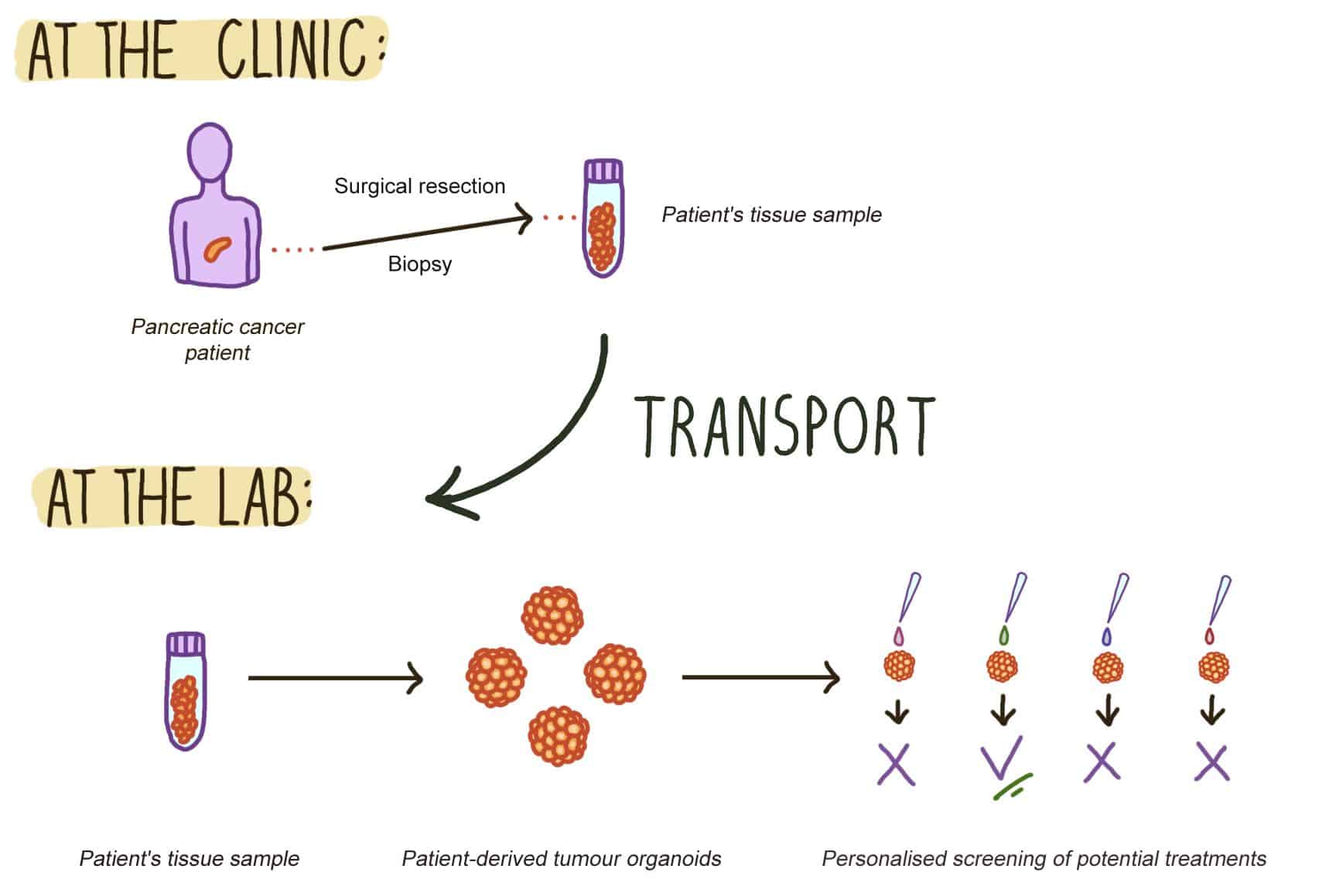 At the clinic: Imagine of pancreatic cancer patient with an arrow labelled surgical resection/biopsy pointing to an image of the patient's tissue sample. An arrow suggests the tissue sample is transported to the lab. At the lab: The tissue sample is turned into patient-derived tumour organoids then personalised screening of potential treatments