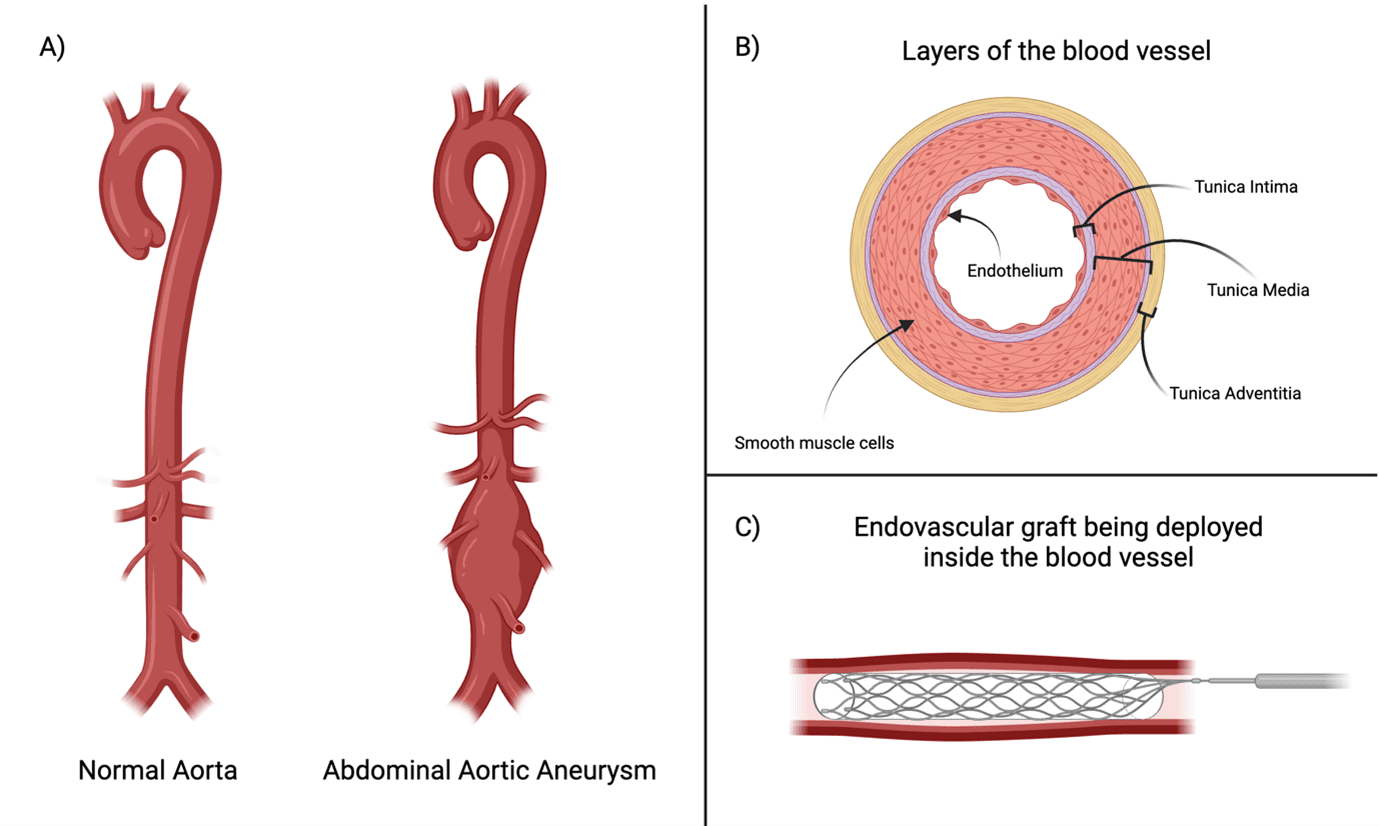 Figure 1. (A) A healthy aorta in comparison to an aorta with an abdominal aneurysm, illustrating how the aorta bulges. (B) Cross-sectional diagram of the different layers of the blood vessel. (C) An example illustration of the vascular graft within the blood vessel following implantation.